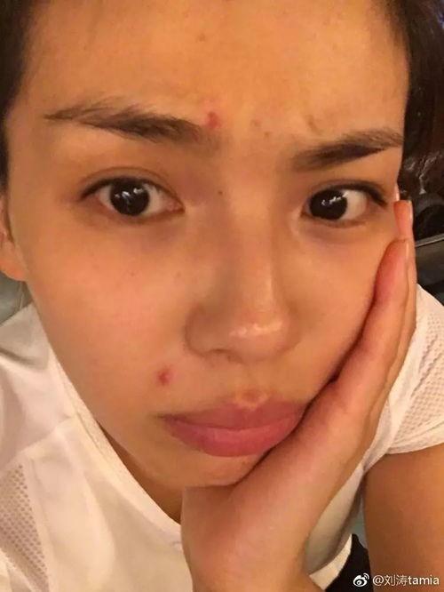 明星长痘,揭秘明星如何战胜痘痘困扰